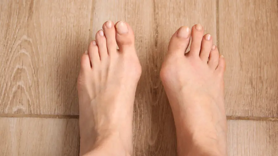 Bunions