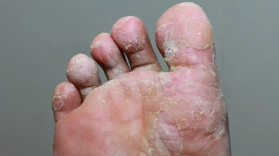 Skin Conditions