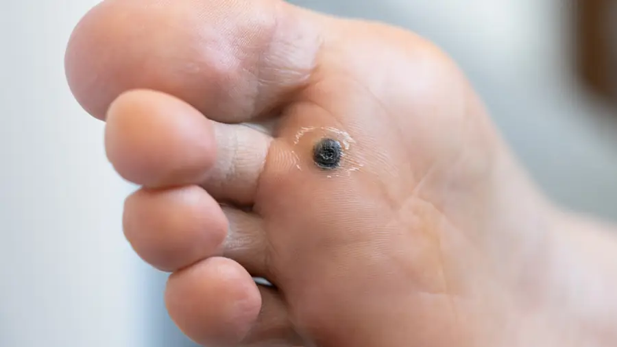 Wart Removal