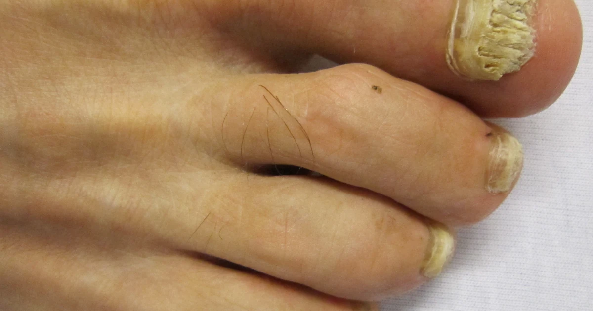 A podiatrist in a bright clinical room examines a thickened discolored toenail before recommending treatment.
