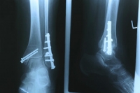 What Causes a Stress Fracture to Occur?