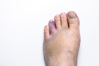 Broken Toe Symptoms Are Difficult to Dismiss